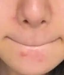 Çene ve Burun Kenarındaki Sivilce Sorunları: Perioral Dermatit ve Etkili Cilt Bakımı Yöntemleri