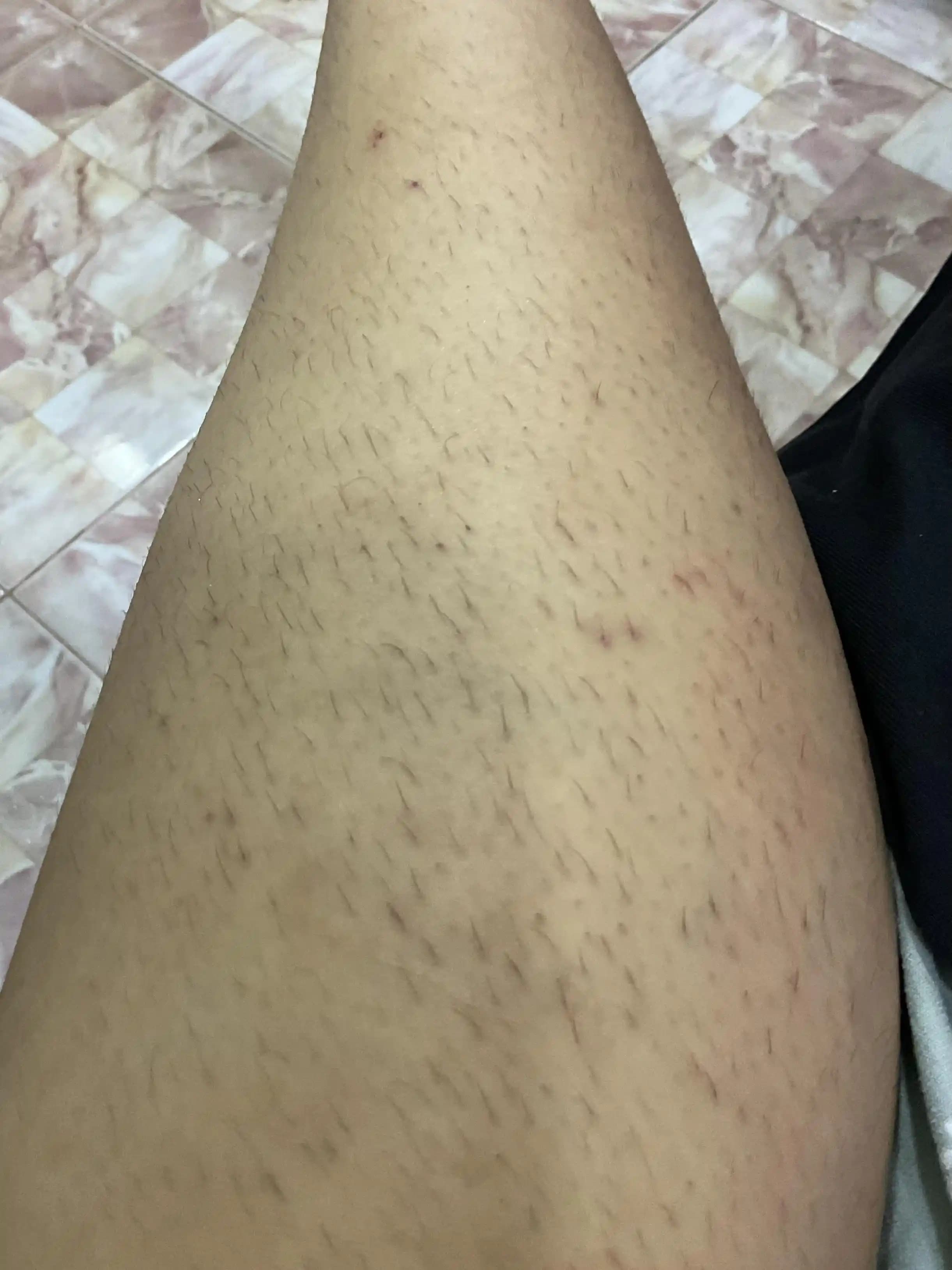 Kıl Dönmesi Sorunları ve Etkili Çözüm Yöntemleri: Kimyasal Eksfoliasyon ve Epilasyon Teknikleri