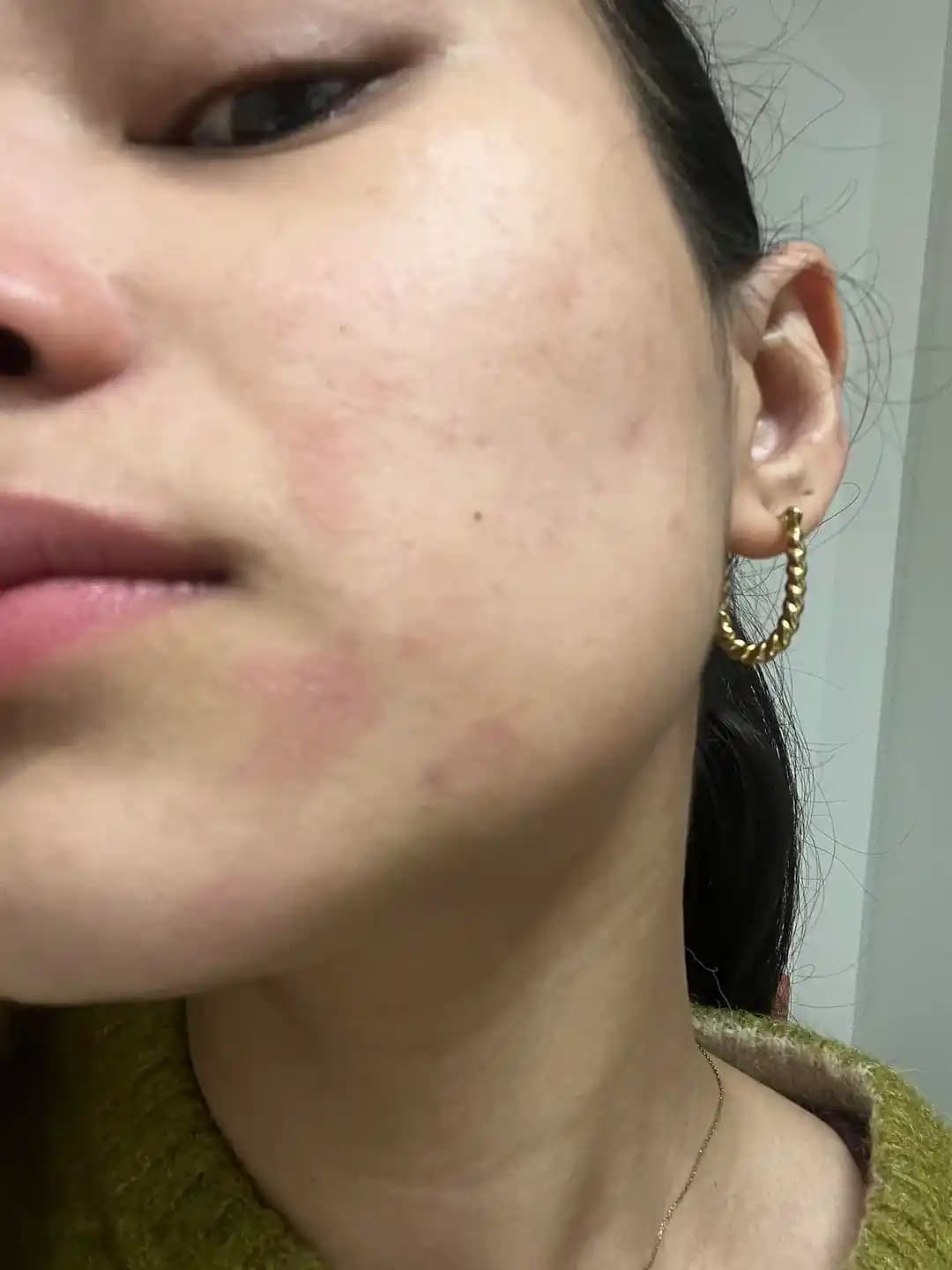 Retinol Sonrası Hasar Görmüş Cilt Bariyerini Onarmak İçin Etkili Bakım Yöntemleri ve Dikkat Edilmesi Gerekenler