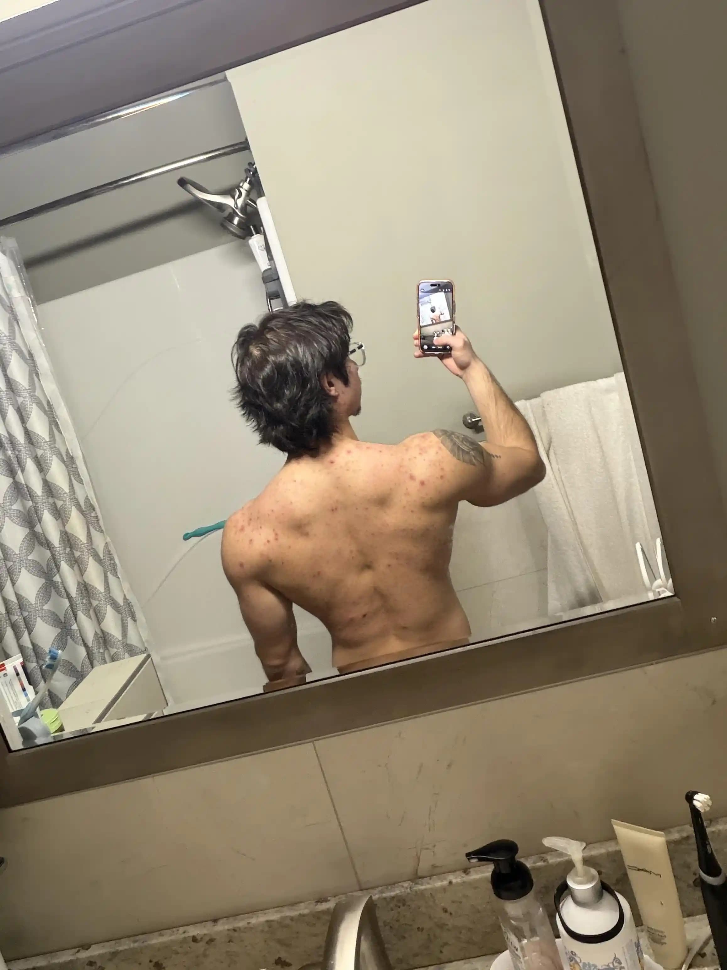 Sırt Aknesi Tedavisi ve Önleme Yöntemleri: Etkili Yaklaşımlar ve Uzman Önerileri