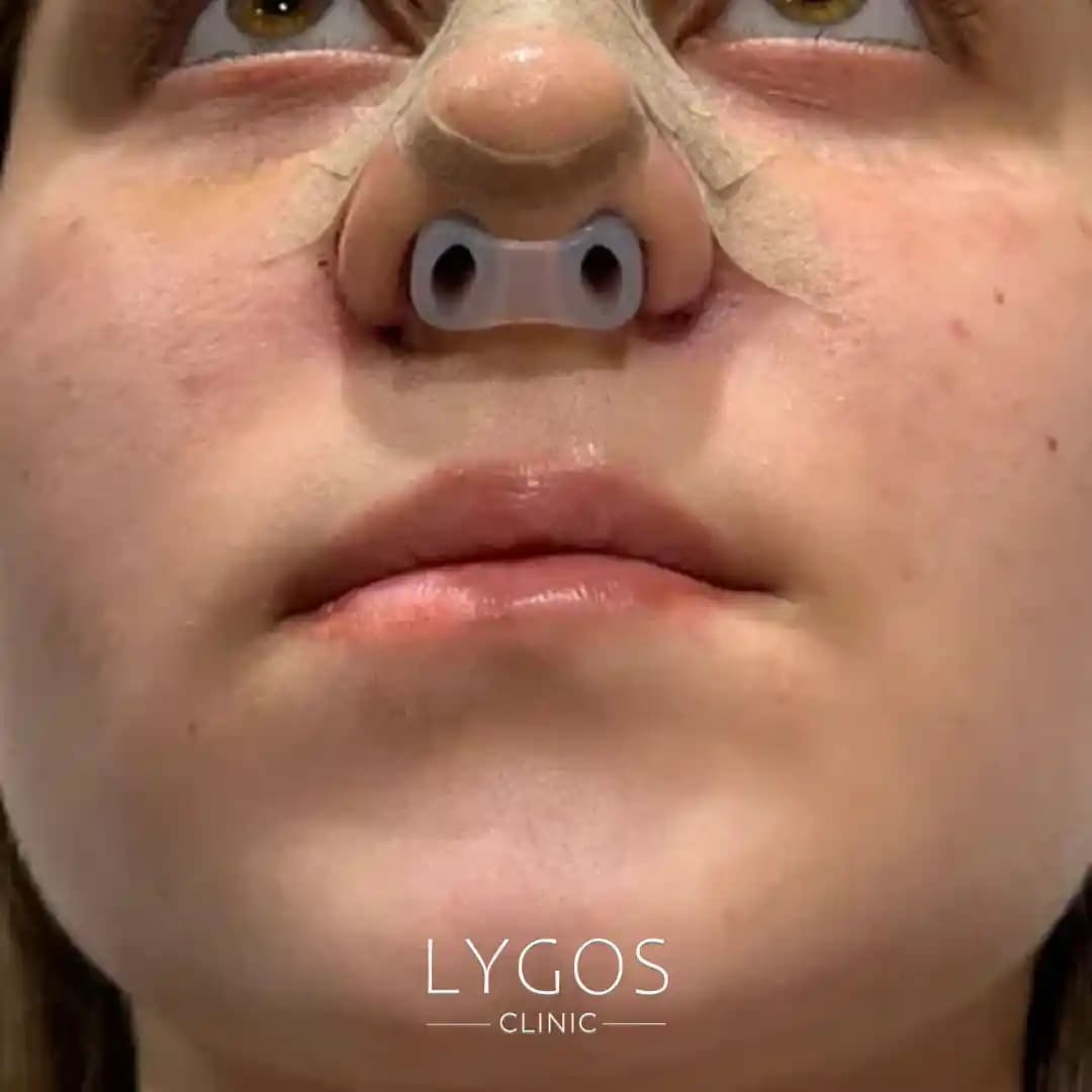 Burun Nostril Retainerları: Estetik ve Geçici Çözümler Hakkında Detaylı Bilgi