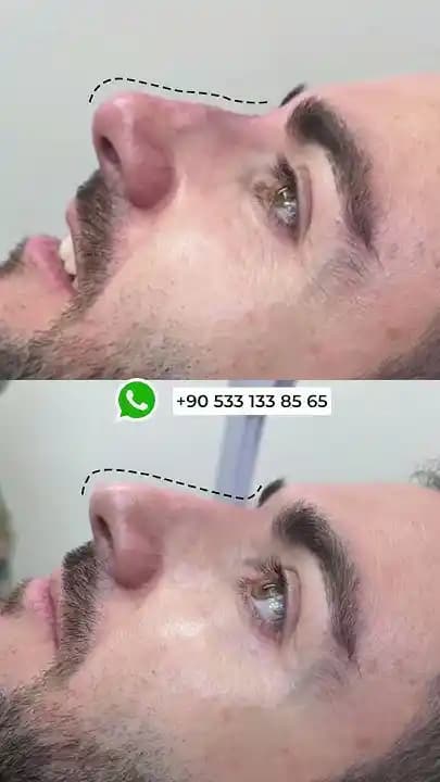 Burun Şekillendirmede Pratik ve Estetik Çözümler: Cerrahi Olmayan Yöntemler ve Teknolojik Yaklaşımlar