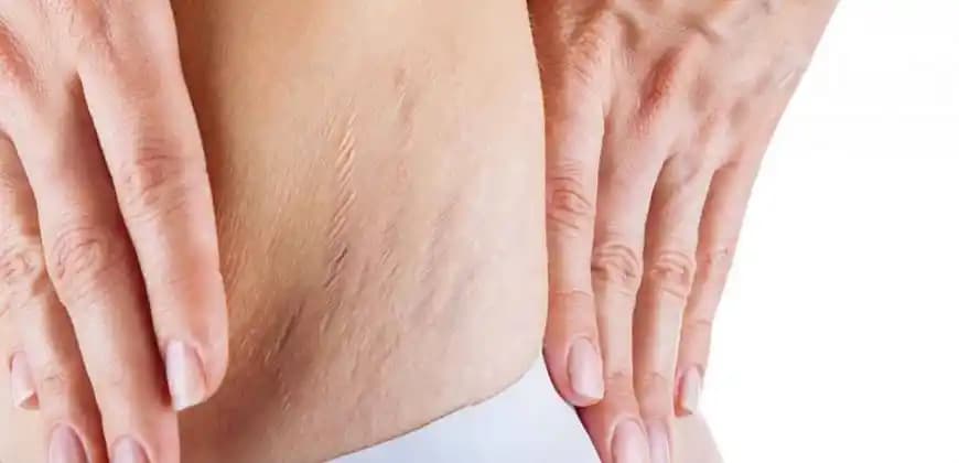 Cilt Çatlağı Nedenleri ve Etkili Çözüm Yolları Hakkında Kapsamlı Bilgi