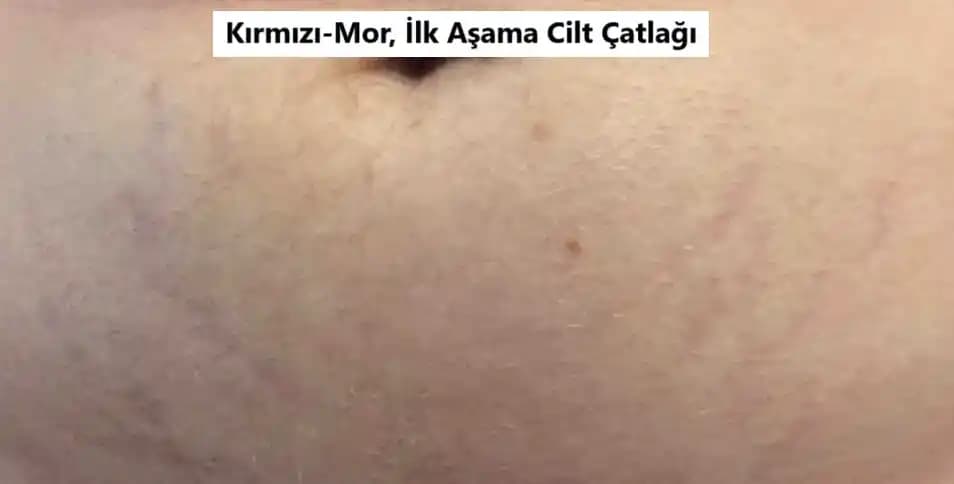Cilt Çatlağı Nedir, Belirtileri, Nedenleri ve Etkili Tedavi Yöntemleri