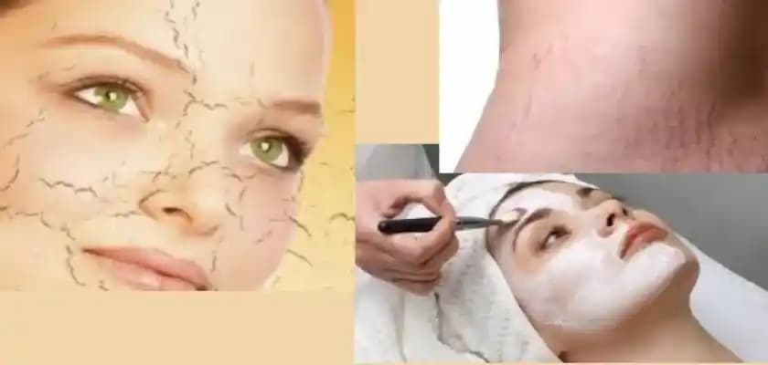 Cilt Çatlağı Önleme Yöntemleri ve Güncel Yaklaşımlar Hakkında Bilgilendirici Rehber