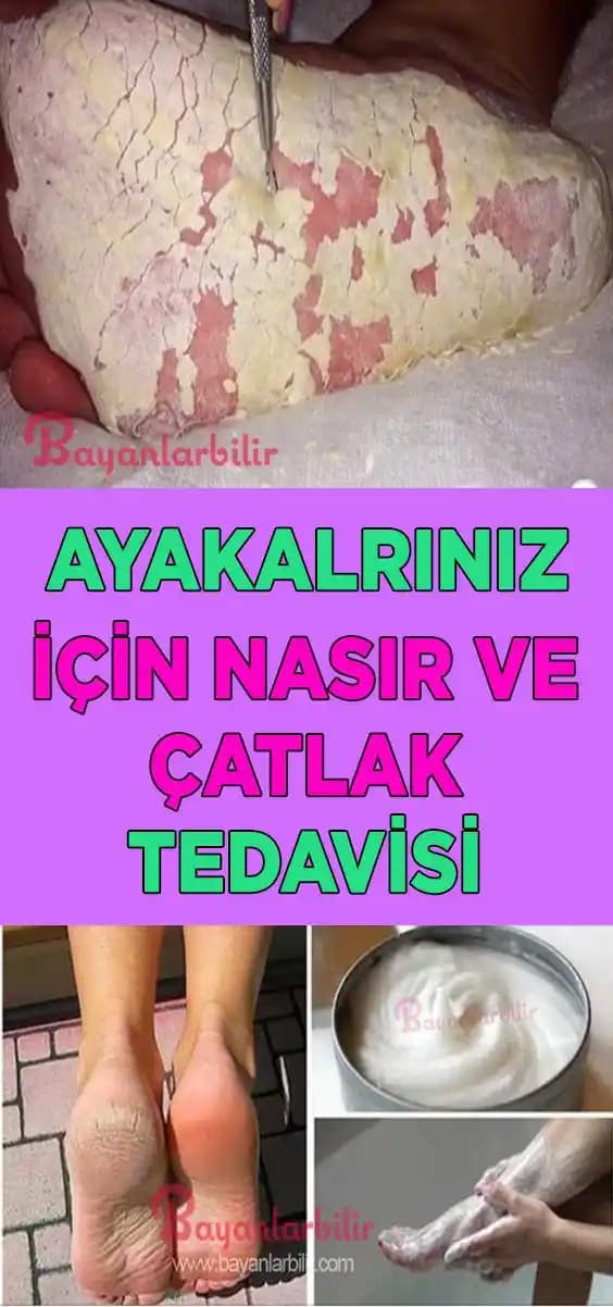 Cilt Çatlağı Tedavisinde Güncel Yöntemler ve Doğal Alternatifler