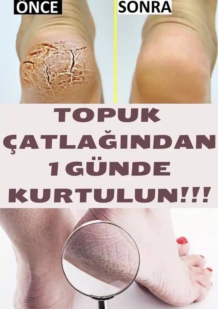 Cilt Çatlağına Karşı Doğal Yöntemler ve Cilt Sağlığını Destekleme