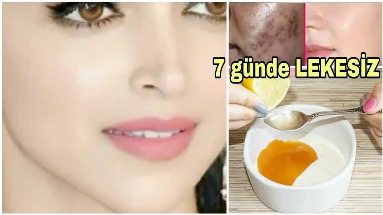 Cilt Lekeleri ve Giderici Yöntemler: Güneş Koruma ve Medikal Çözümler