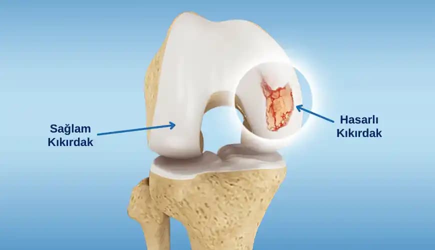 Dizlik Manisküs Kıkırdak Tedavisi Güncel Yaklaşımlar ve Dikkat Edilmesi Gerekenler