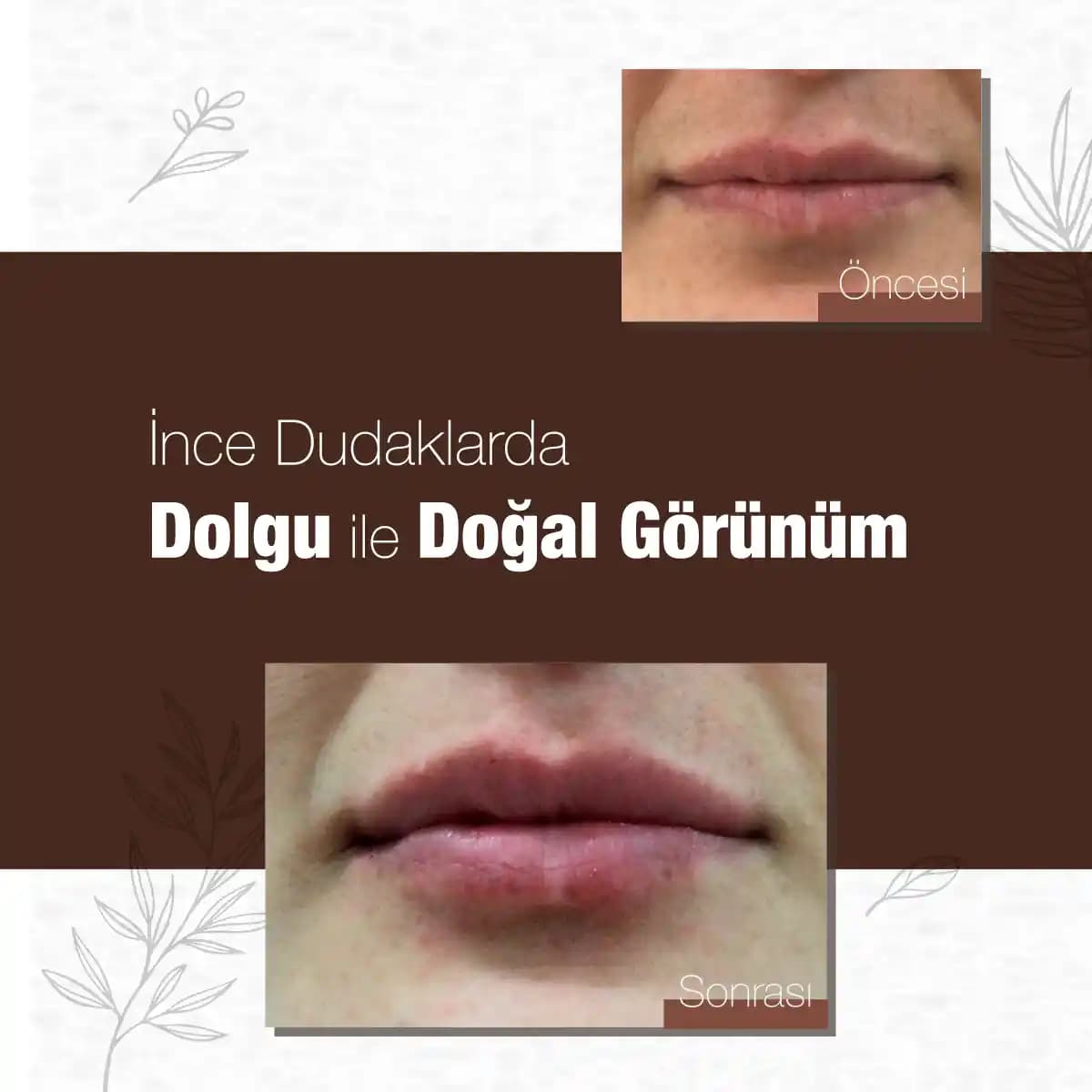 Dudaklarda Sağlıklı Görünüm İçin Günlük Bakım ve Koruma Rehberi