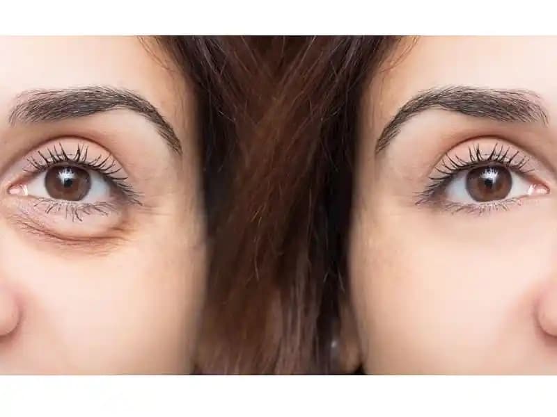 Göz Torbaları ve Şişlikleri: Nedenleri ve Etkili Çözüm Yöntemleri