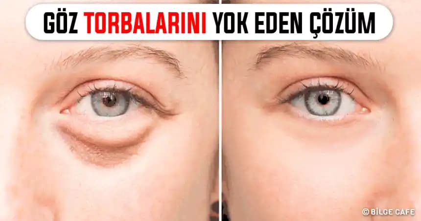Göz Torbaları ve Şişliklerini Azaltma Yöntemleri ve Etkili Ürünler Rehberi