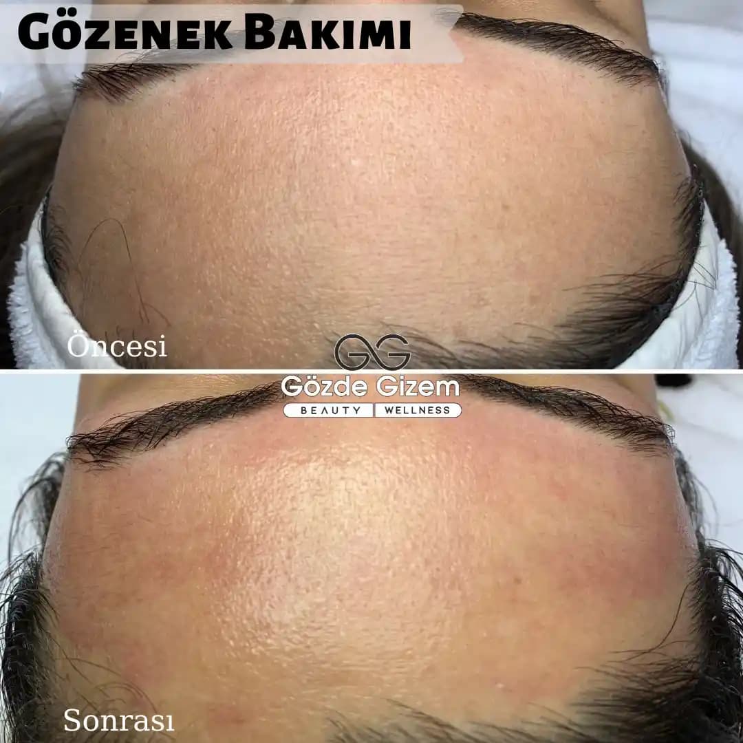 Gözle Görülen Cilt Sıkılaştırma Yöntemleri ve Teknolojileri Hakkında Bilgi