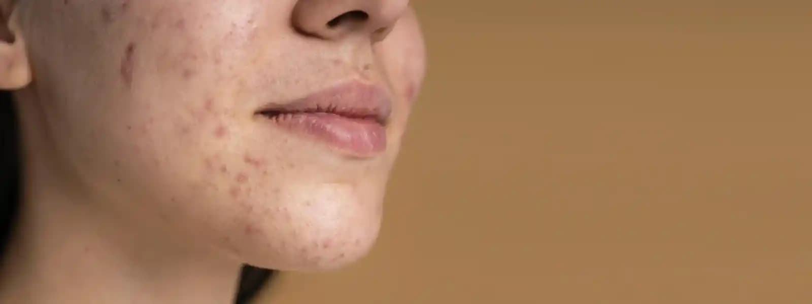 Çene Bölgesinde Sivilce Nedenleri ve Etkili Tedavi Yöntemleri Hakkında Güncel Bilgiler