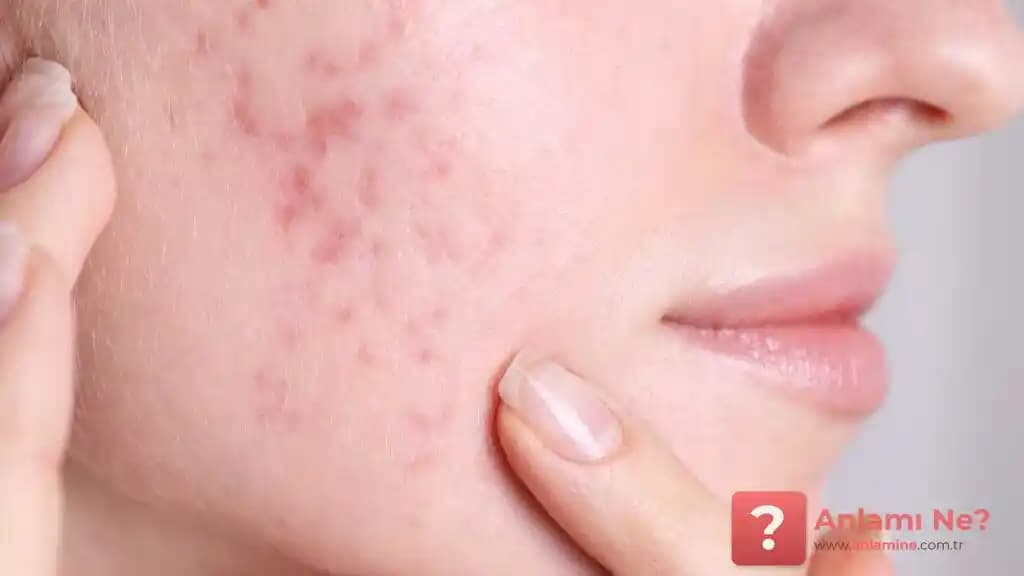 Çene Sivilcesi İçin Güncel ve Doğal Tedavi Yöntemleri Hakkında Bilgi