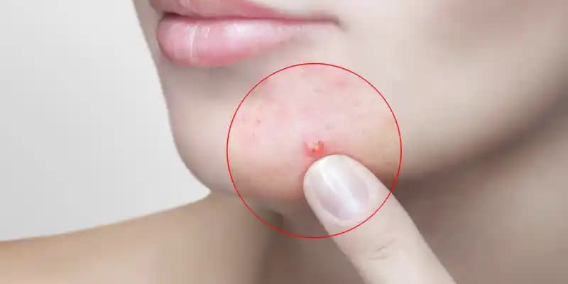 Çene Sivilcesi Türleri ve Etkili Tedavi Yöntemleri Hakkında Bilgiler