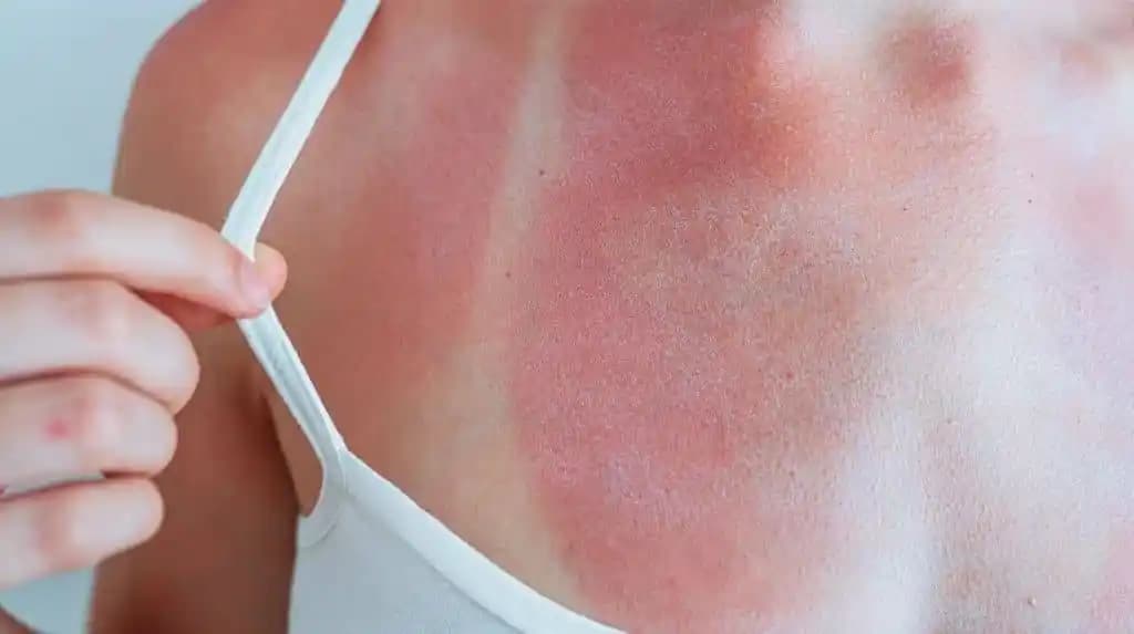 Güneş Yanığını Önlemek İçin Doğal Yöntemler ve Cilt Koruma İpuçları