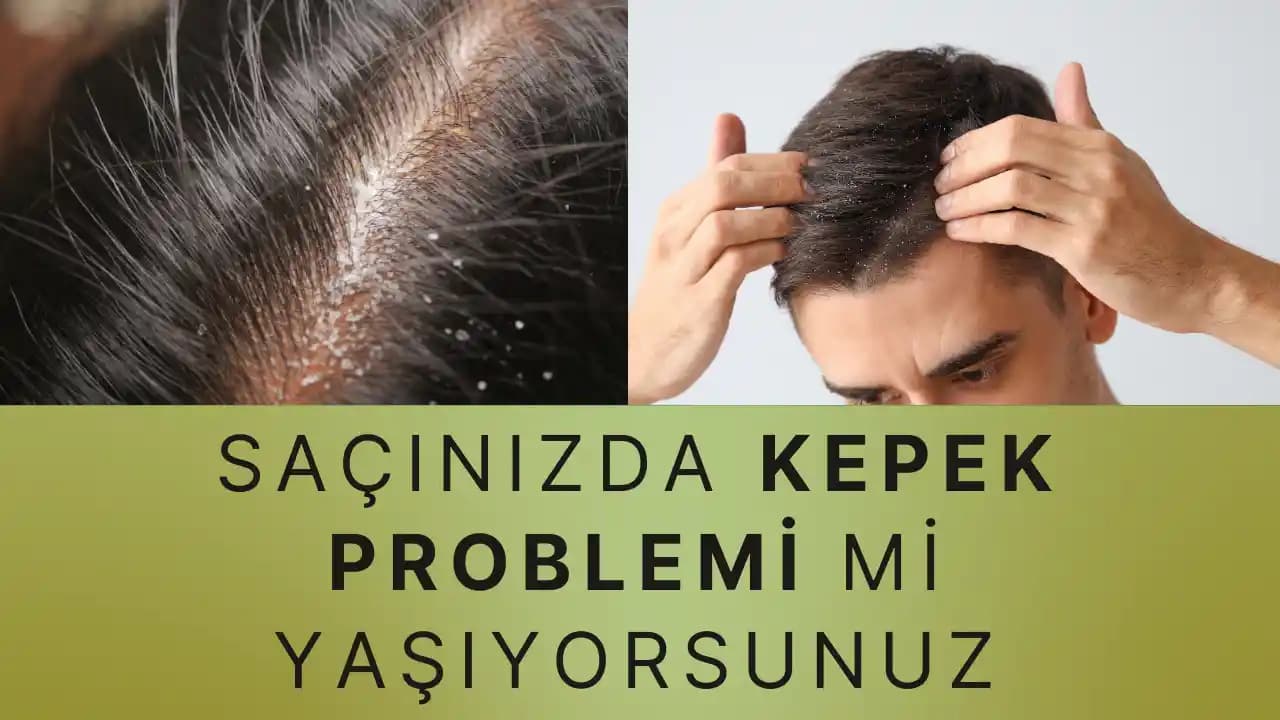 Kepek Sorunu İçin Doğru Şampuan Seçimi ve Kullanım İpuçları