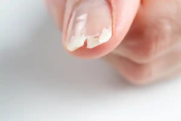 Kırık ve Güçsüz Tırnaklar İçin Etkili Bakım Yöntemleri ve Doğal Çözümler