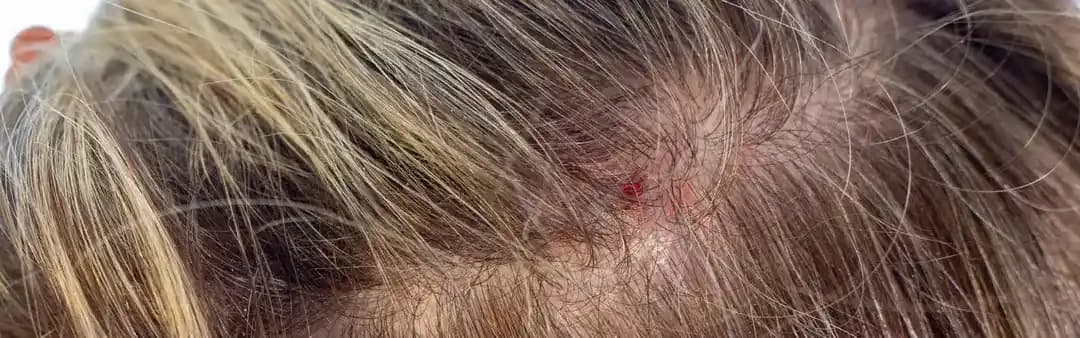 Saç Derisinde Kabuklanma ve Kaşıntı Nedenleri ile Etkili Çözüm Yolları