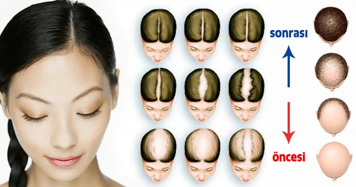 Saç Dökülmesi ve Kepeği Önleyen Etkili Yöntemler ve Bakım Tavsiyeleri