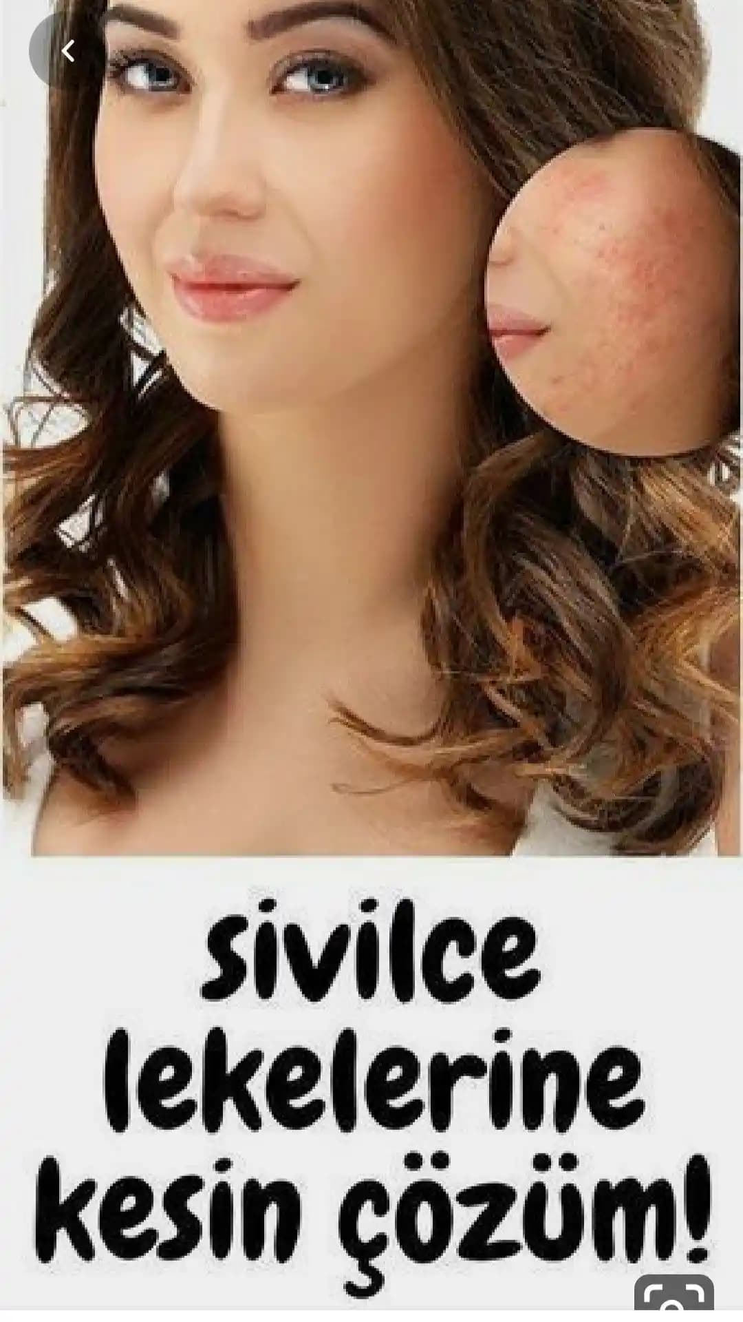 Sivilceye Karşı Etkili Çözüm Yolları ve Cilt Bakım Önerileri