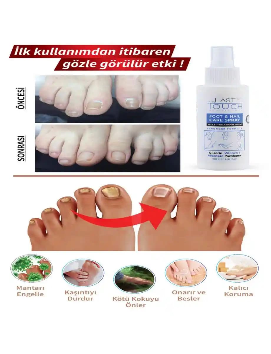 Tırnak Mantarı Tedavisinde Güncel Yaklaşımlar ve Önleyici Adımlar Hakkında Bilgi