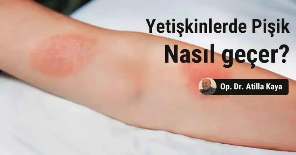 Yetişkinlerde Pişik Nedenleri ve Etkili Önleme Yöntemleri Hakkında Kapsamlı Bilgi