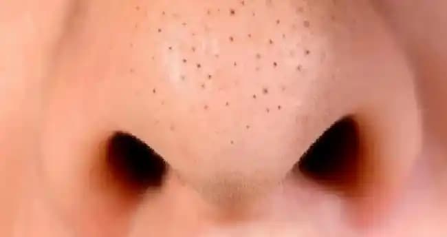 3 Yaşındaki Çocuklarda Siyah Noktaların Nedenleri ve Uygun Cilt Bakımı Yöntemleri