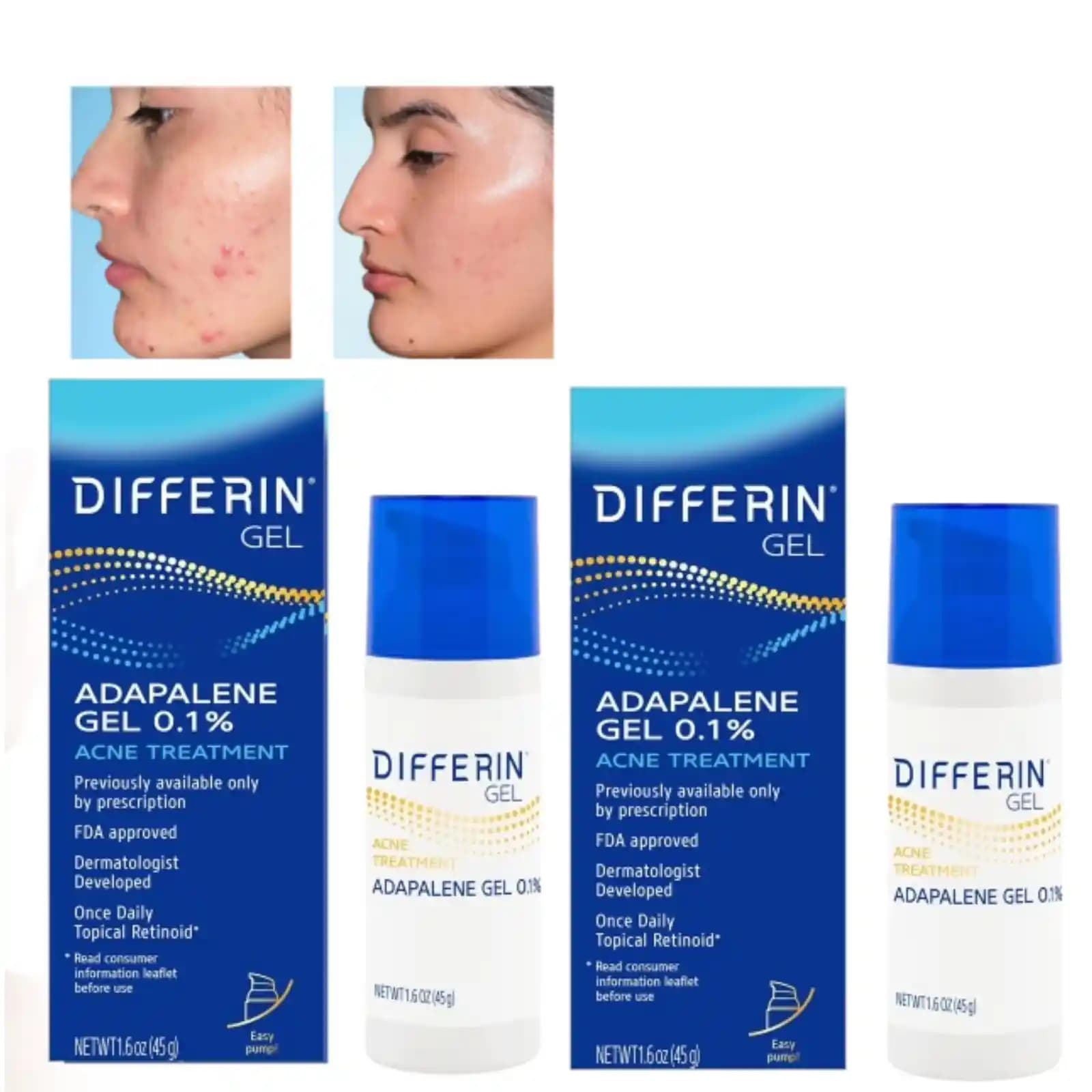 Adapalene Kullanımı ve Retinoid Purging Sürecinde Ciltteki Değişimler ve İyileşme Süreci