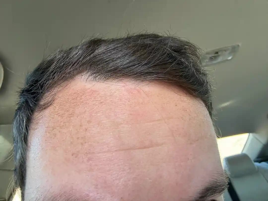 Alın Bölgesinde Melazma ve Güneş Hasarının Nedenleri, Tanısı ve Tedavisi