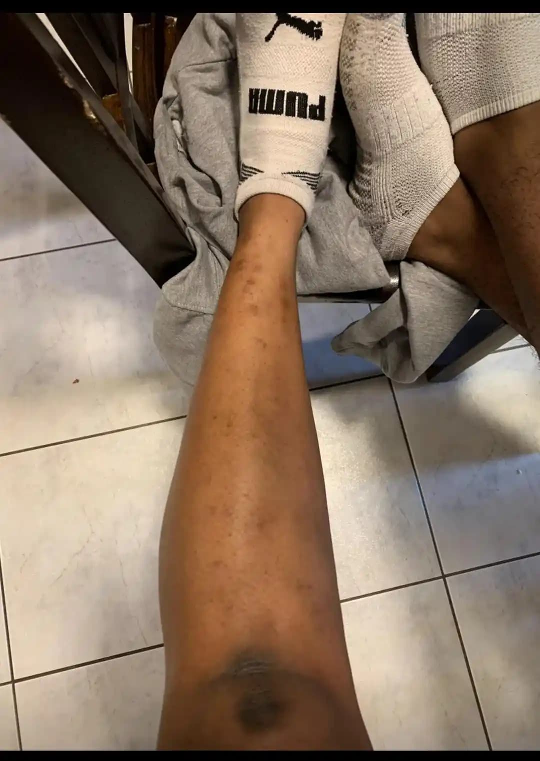 Bacaklarda Kaşıntı ve Cilt Hasarının Nedenleri ile Etkili Çözüm Yöntemleri