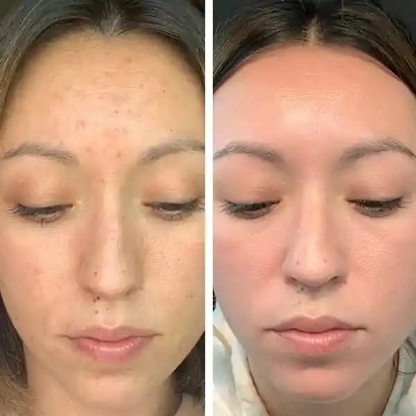 Cilt Eksfoliasyonu: Yöntemler, Ürünler ve Doğru Uygulama Rehberi