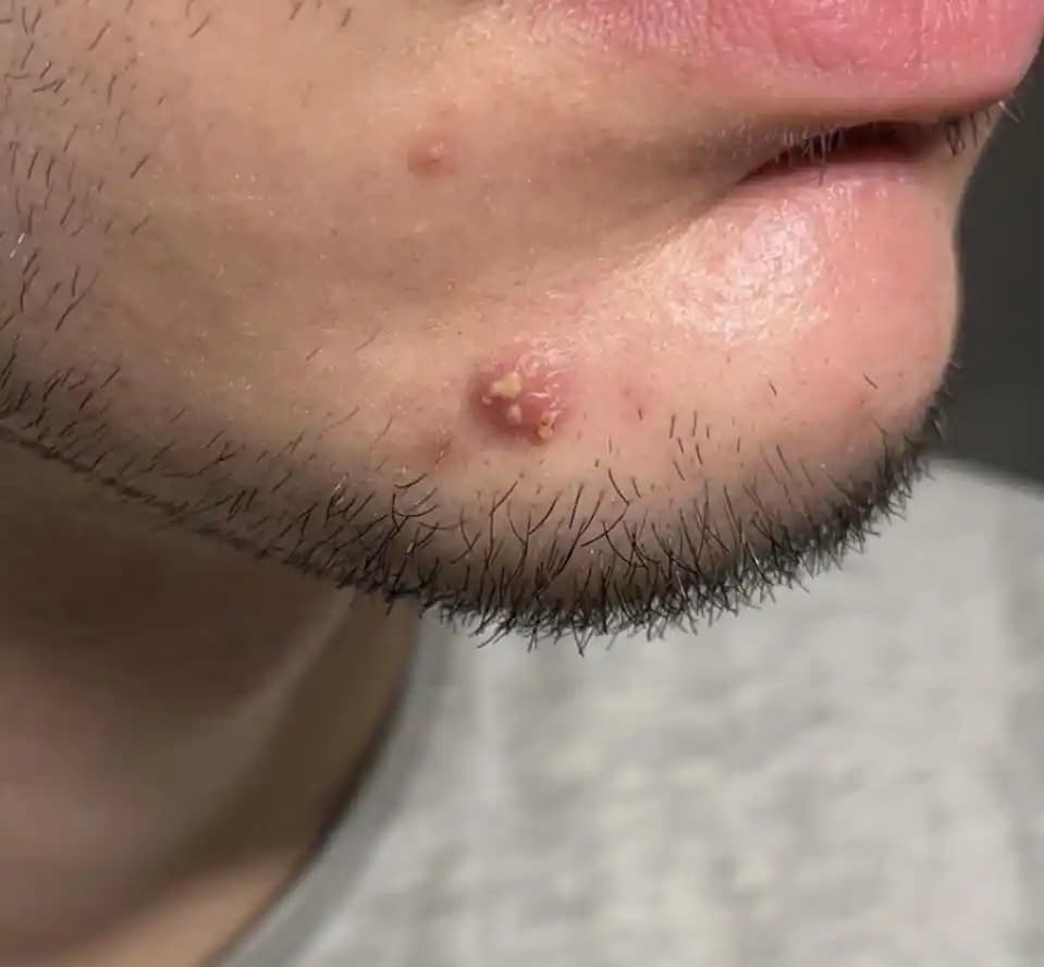 Çok Başlı Sivilceler: Nedenleri, Tedavi Yöntemleri ve Uzman Görüşleri