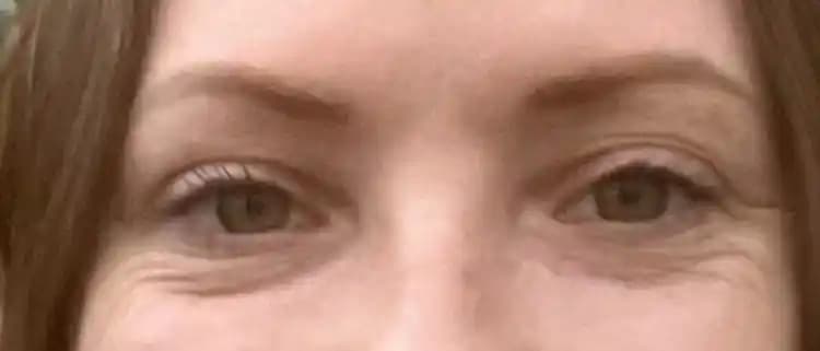 Göz Altı Kırışıklıklarının Azaltılması İçin Etkili Yöntemler ve Önemli İpuçları