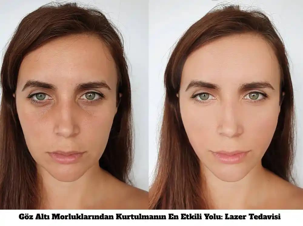 Göz Altı Morluklarının Renk Düzeltme Sonrası Hâlâ Görünmesinin Nedenleri ve Çözüm Yöntemleri