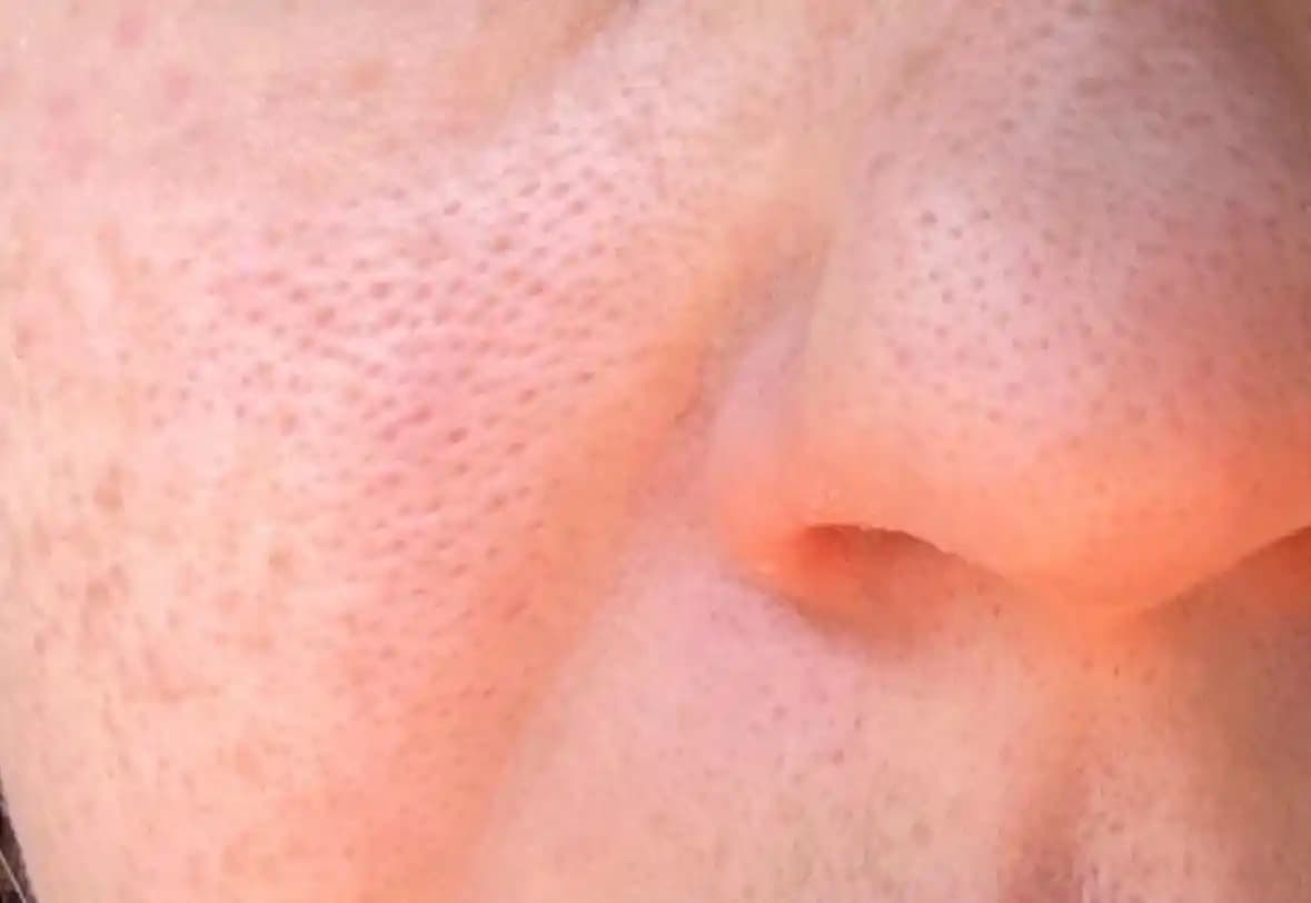 Gözeneklerin Görünümünü İyileştirme Yöntemleri ve Dermatolojik Yaklaşımlar