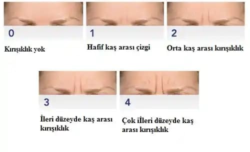 Kaş Arası Kırışıklıkların Nedenleri ve Etkili Tedavi Yöntemleri Hakkında Bilgi