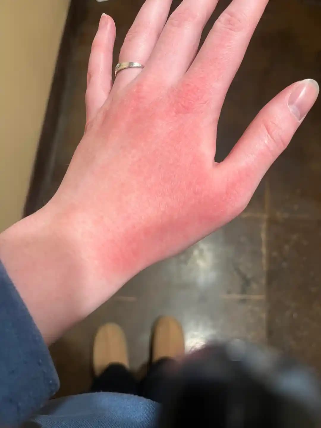 Kış Aylarında Egzama ve El Bakımı: Etkili Tedavi ve Koruyucu Yöntemler