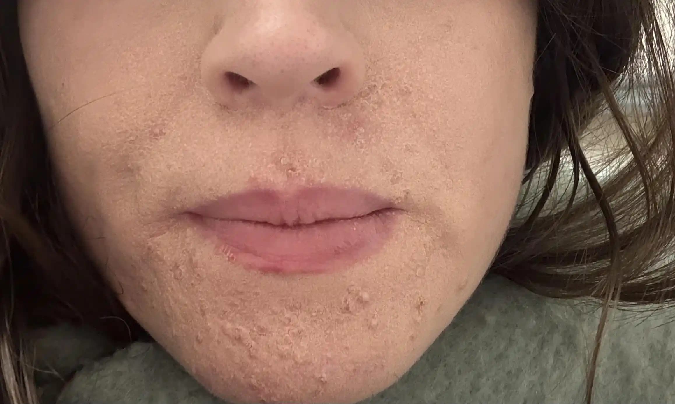 Makyaj Altında Kuru ve Pullanan Cilt Sorunları: Nedenleri ve Etkili Çözümler