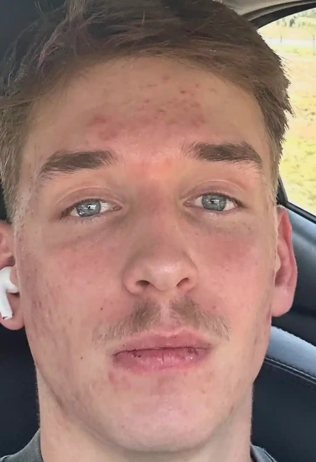 Minosiklinin Akne Tedavisindeki Uzun Vadeli Etkileri ve Tekrarlama Riski