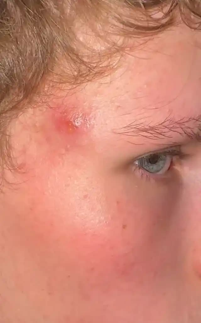 Şakaklarda Tekrarlayan Ağrılı Şişliklerin Nedenleri ve Etkili Tedavi Yöntemleri