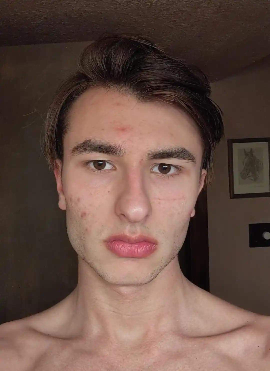 Sivilce Tedavisinde Cilt Bakımı ve Ürün Kombinasyonlarının Önemi