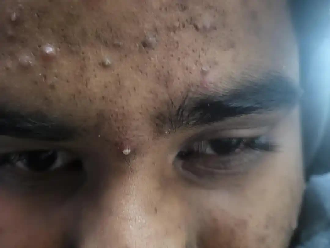 Sivilcelerle Mücadelede Etkili Yöntemler ve Uzman Görüşleri: Cilt Bakımı ve Tedavi Önerileri