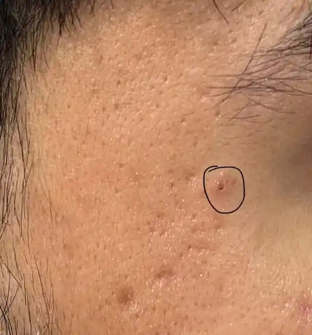 Siyah Noktalar: Tanımı, Tedavi Yöntemleri ve Doğru Uygulama İpuçları