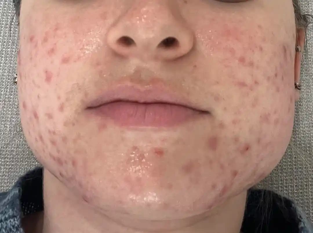 Spearmintin Hormonal Akne Tedavisindeki Rolü ve Kullanım Rehberi