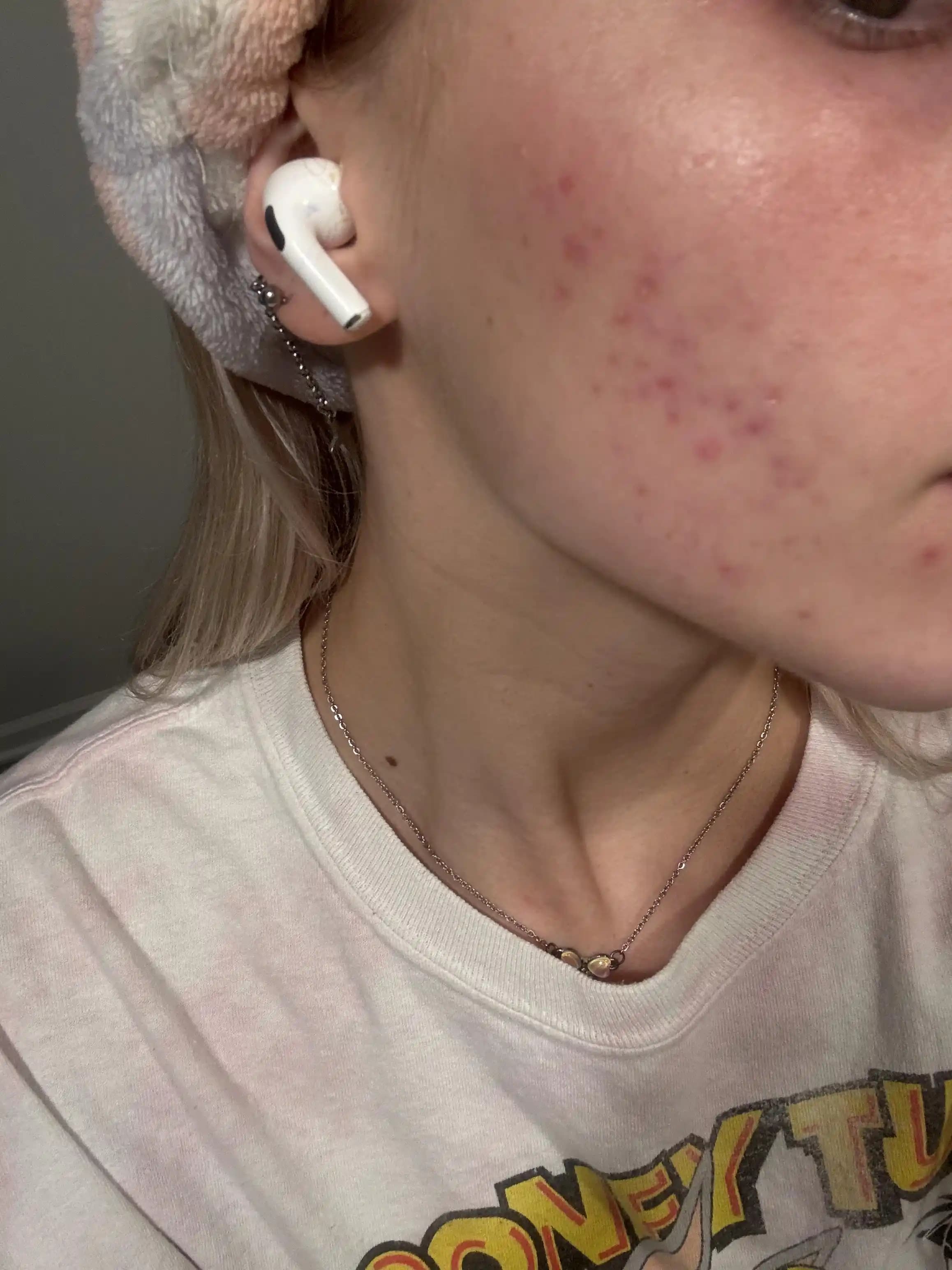 Yüzde Uzun Süredir Devam Eden Akne Problemlerinin Etkili Tedavi Yöntemleri ve Cilt Bakımı