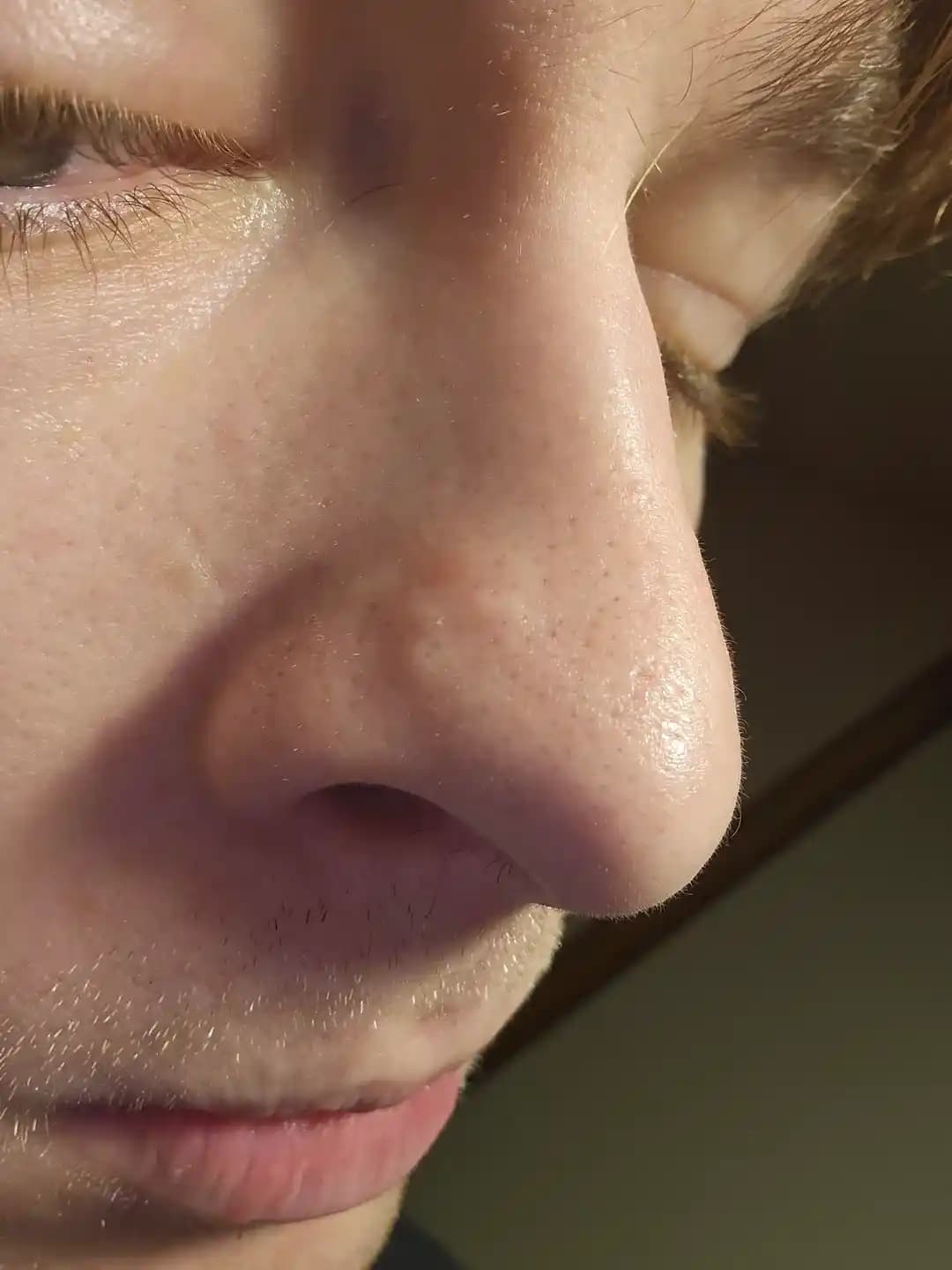 Burundaki Derin Başsız Sivilceler: Nedenleri, Tedavi Yöntemleri ve İz Riskleri