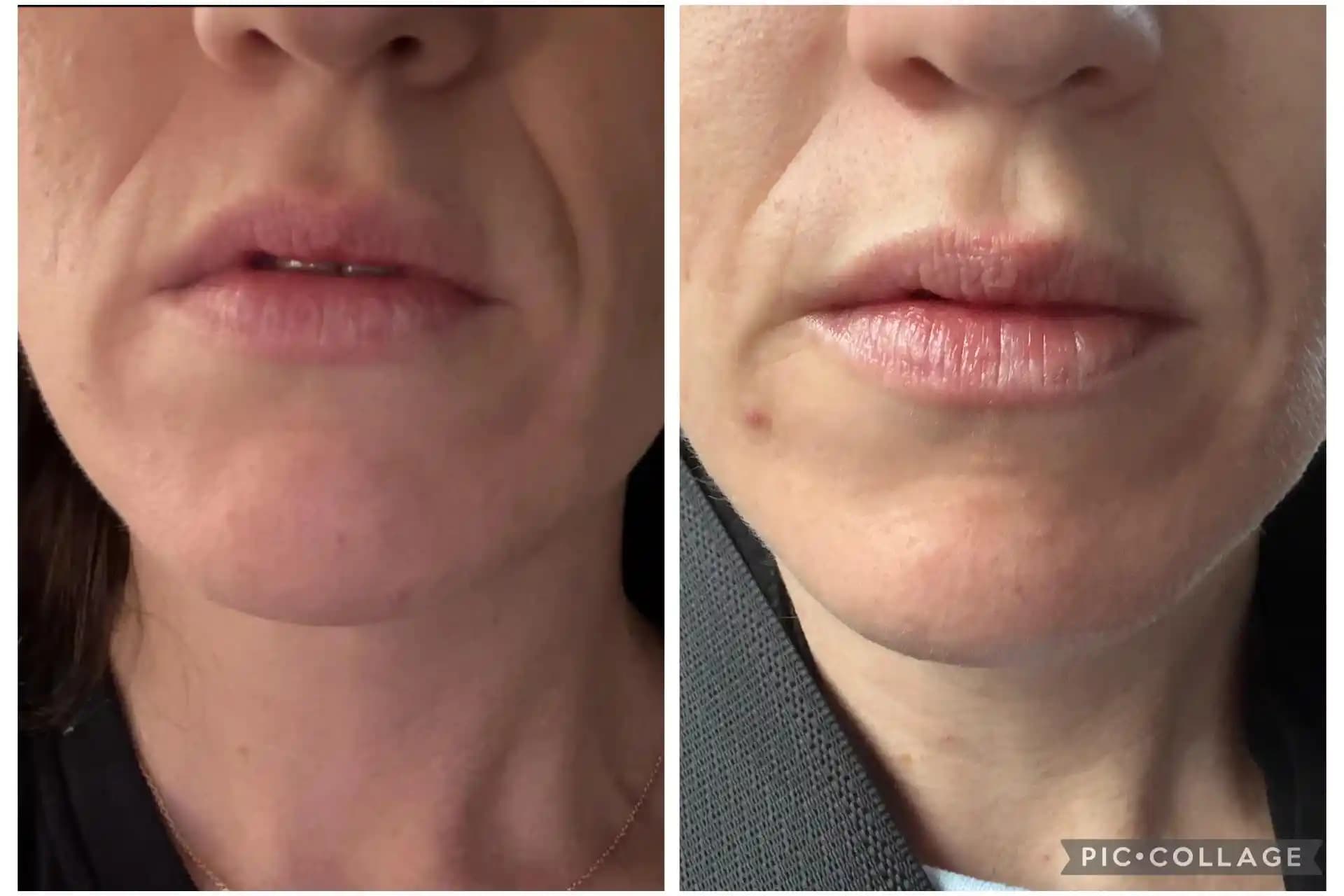 Gülüş Çizgileri: Yapısal Nedenler, Tedavi Yöntemleri ve Cilt Bakımı Yaklaşımları