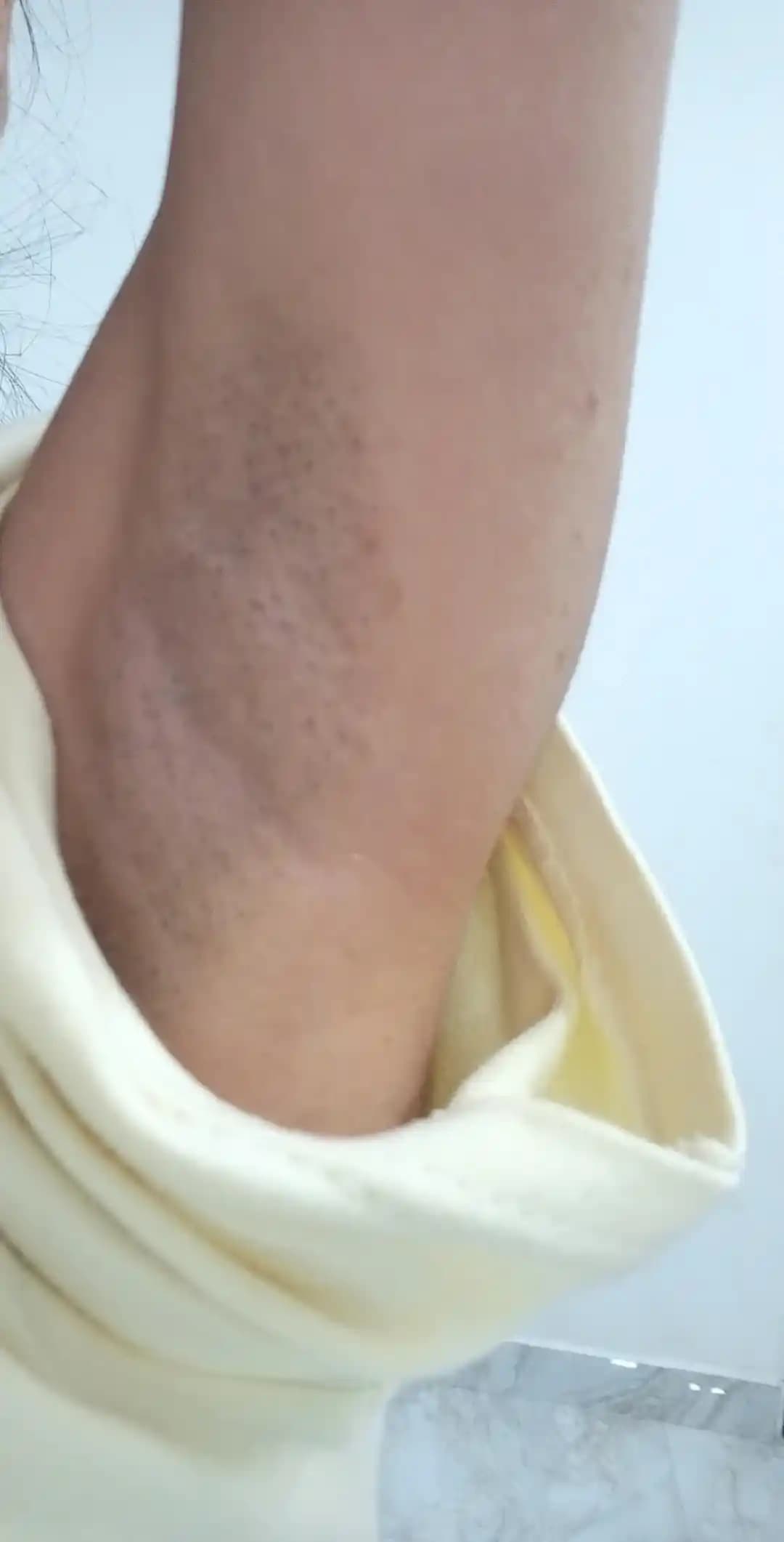 Koltuk Altı Koyu ve Yeşilimsi Renk Sorunları: Nedenleri ve Etkili Çözüm Yöntemleri